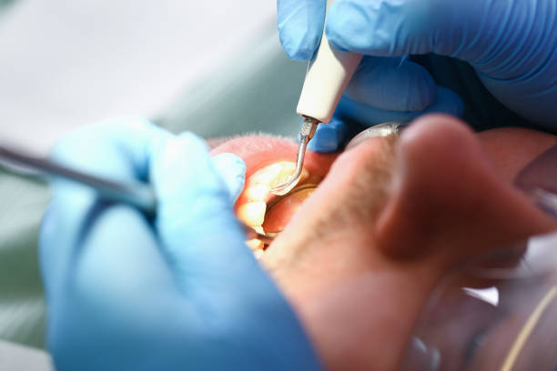 Best Emergency Dental Care for Abscessed Tooth in Ann Arbor, MI
