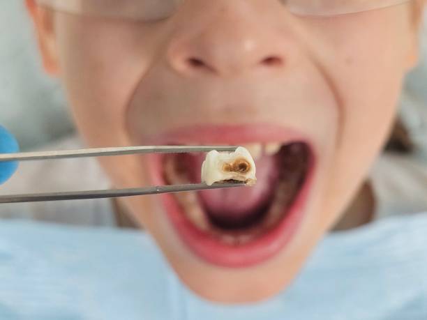 Best Emergency Dental Extractions in Ann Arbor, MI